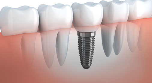 Dental Implants