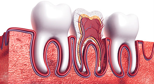 Root Canals